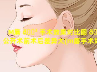 M唇 🌳 手术效果对比图 🕸 公开术前术后差异大(m唇手术效果对比图公开术前术后差异大)